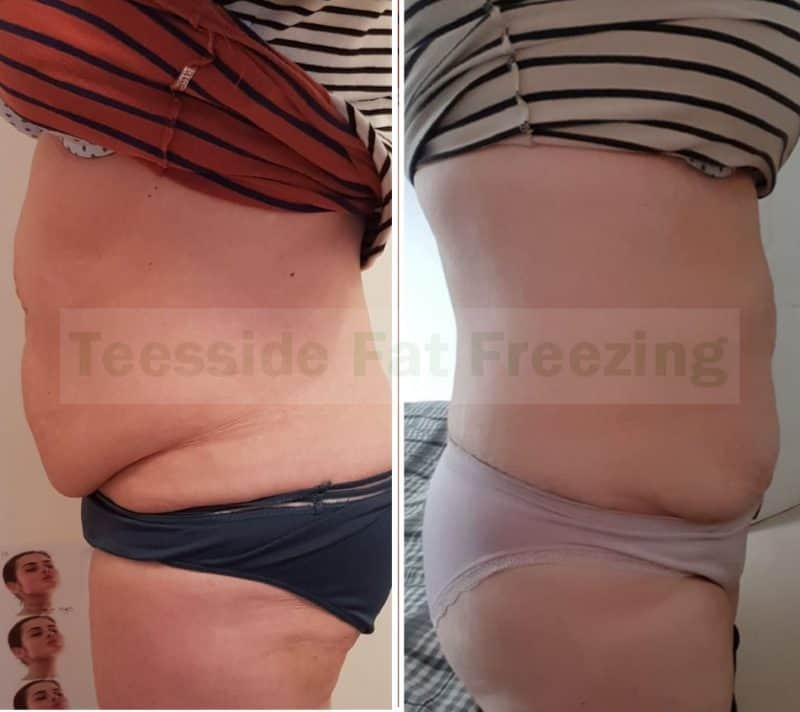 Fat Freezing Abdomen Belly Buster before and after 6 weeks