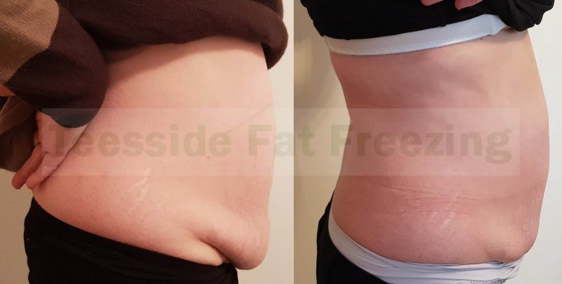 Cryolipolysis Abdomen Before and After Photo 10 weeks post treatment side view