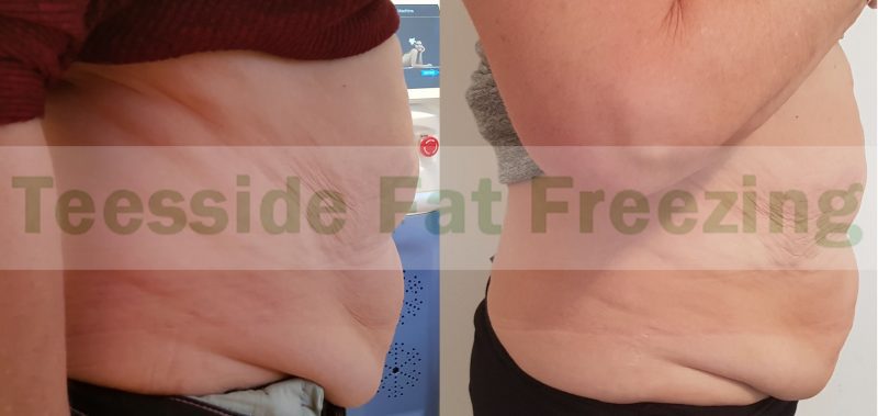 Abdomen Before and After 2 treatments