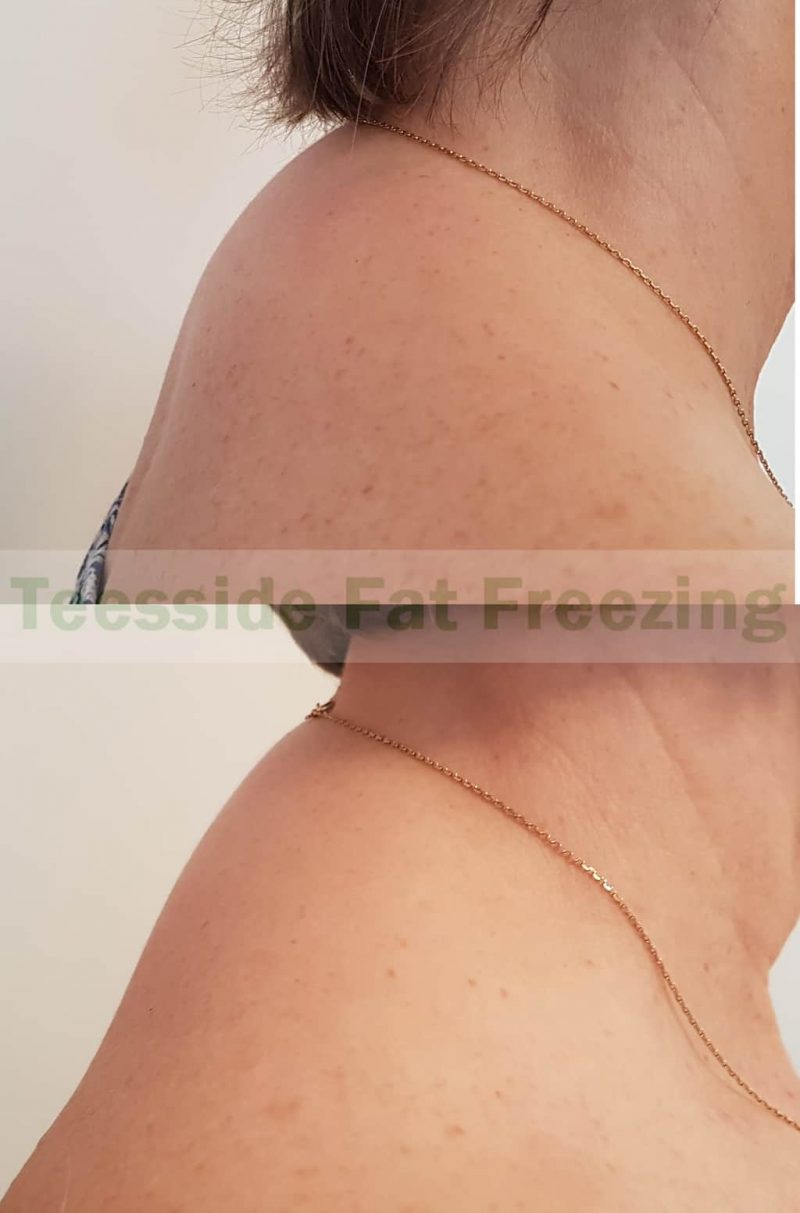 Upper back hump of fat, before and after cryo