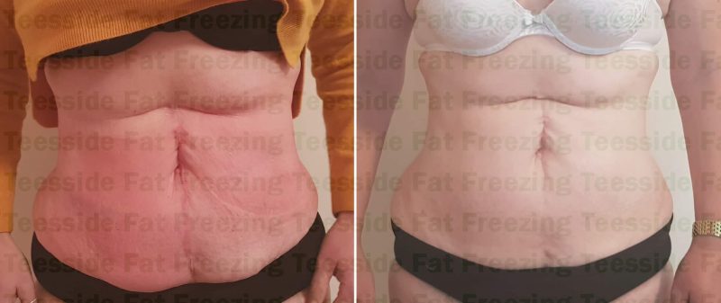 Cryolipolysis reduces fat and can reduce the appearance of a scar