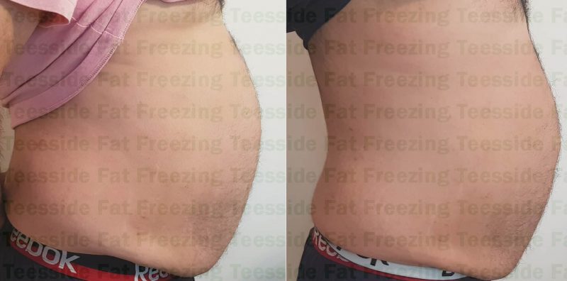 Male abdomen before and 9 weeks after cryolipolysis