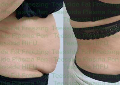 Belly Buster one treatment