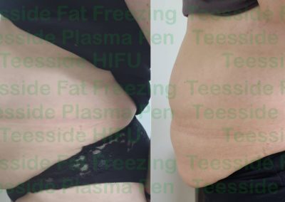 fat freezing tummy before and after