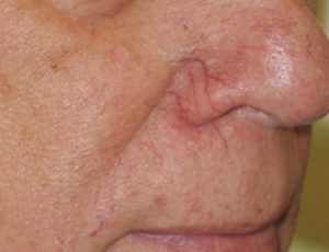 thread veins on the nose