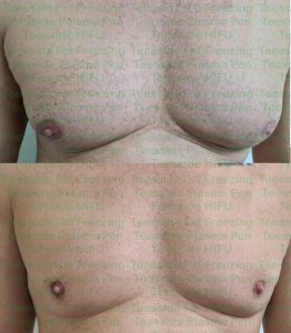 male breast tissue before and after