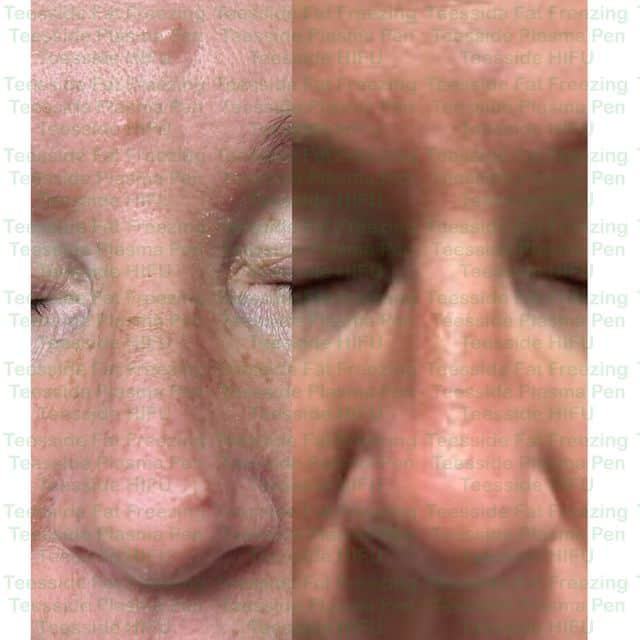 Upper eye lift before and after
