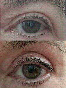 Upper eye lift before and after