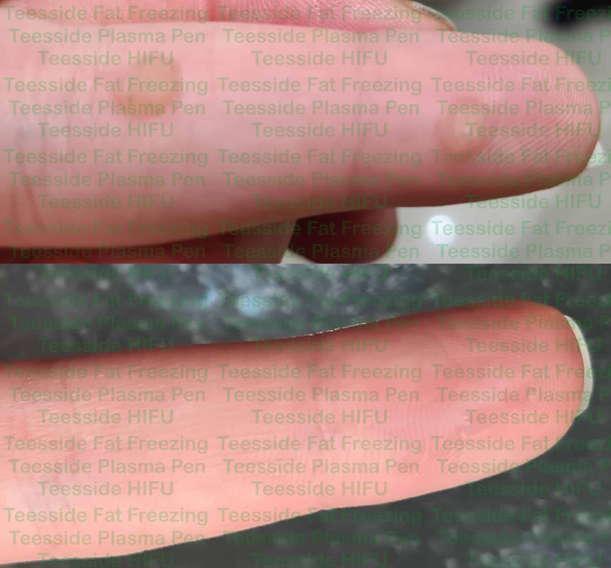 Warts on finger, before and after removal with plasma pen