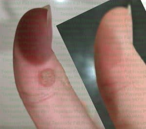 Wart on thumb, before and after removal with plasma pen
