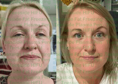 HIFU face lift before and after photo
