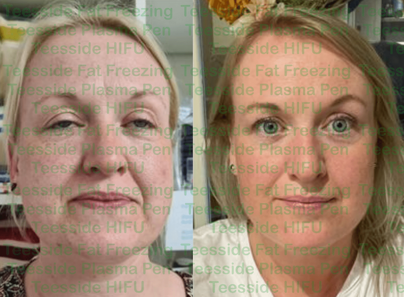 HIFU face lift before and after photo