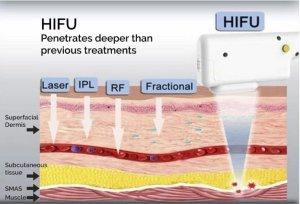 Hifu versus radiofrequency (endymed, pelleve, thermage)