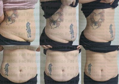 fat freezing two sessions