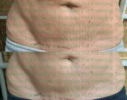 RF microneedling for stretch marks on abdomen before and after